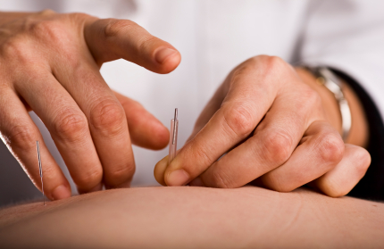 Tapping in acupuncture needle WHAT IS TRIGGER POINT DRY NEEDLING AND HOW IS IT USED IN PHYSICAL THERAPY?